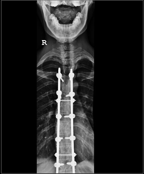 photo Spine xray 1_zpsxnyqsrzh.jpg