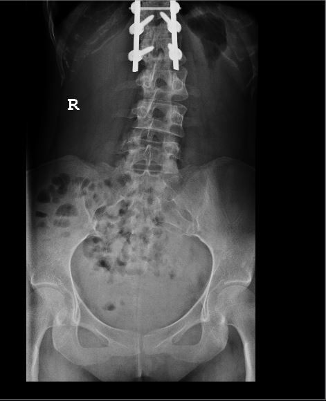 photo Spine xray 2_zpsvrwqepka.jpg