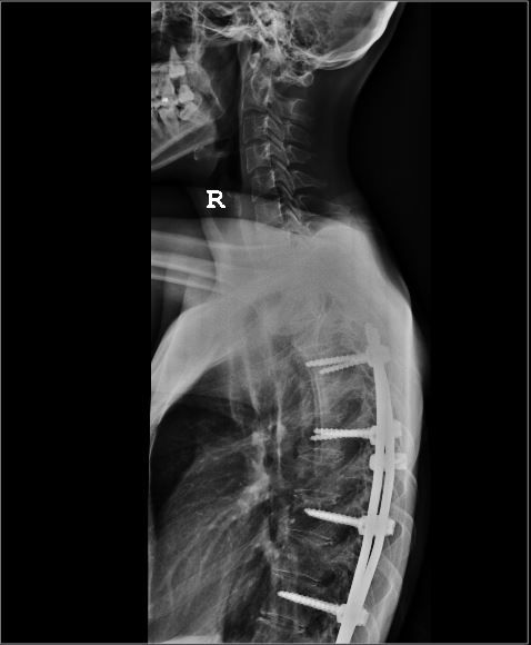 photo Spine xray 3_zpsv5uhqyht.jpg