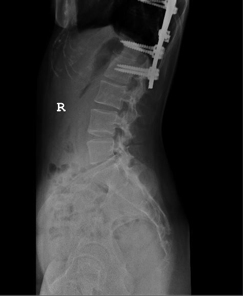 photo Spine xray 4_zpso2seetmn.jpg